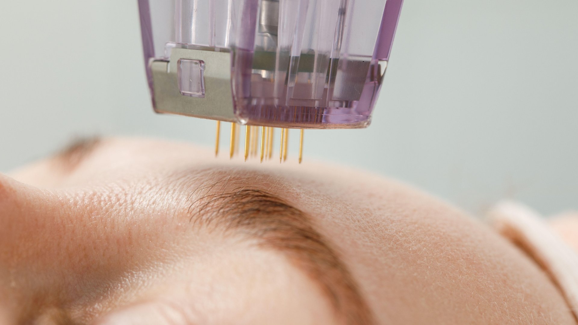 Face microneedling collagen induction therapy